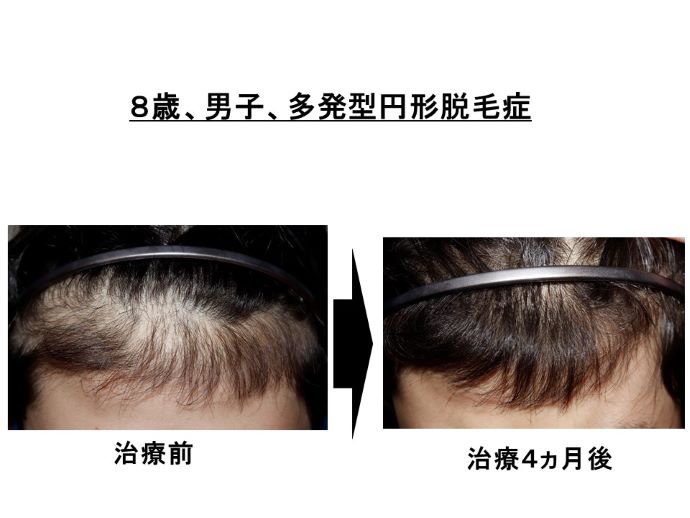 円形脱毛症　病院